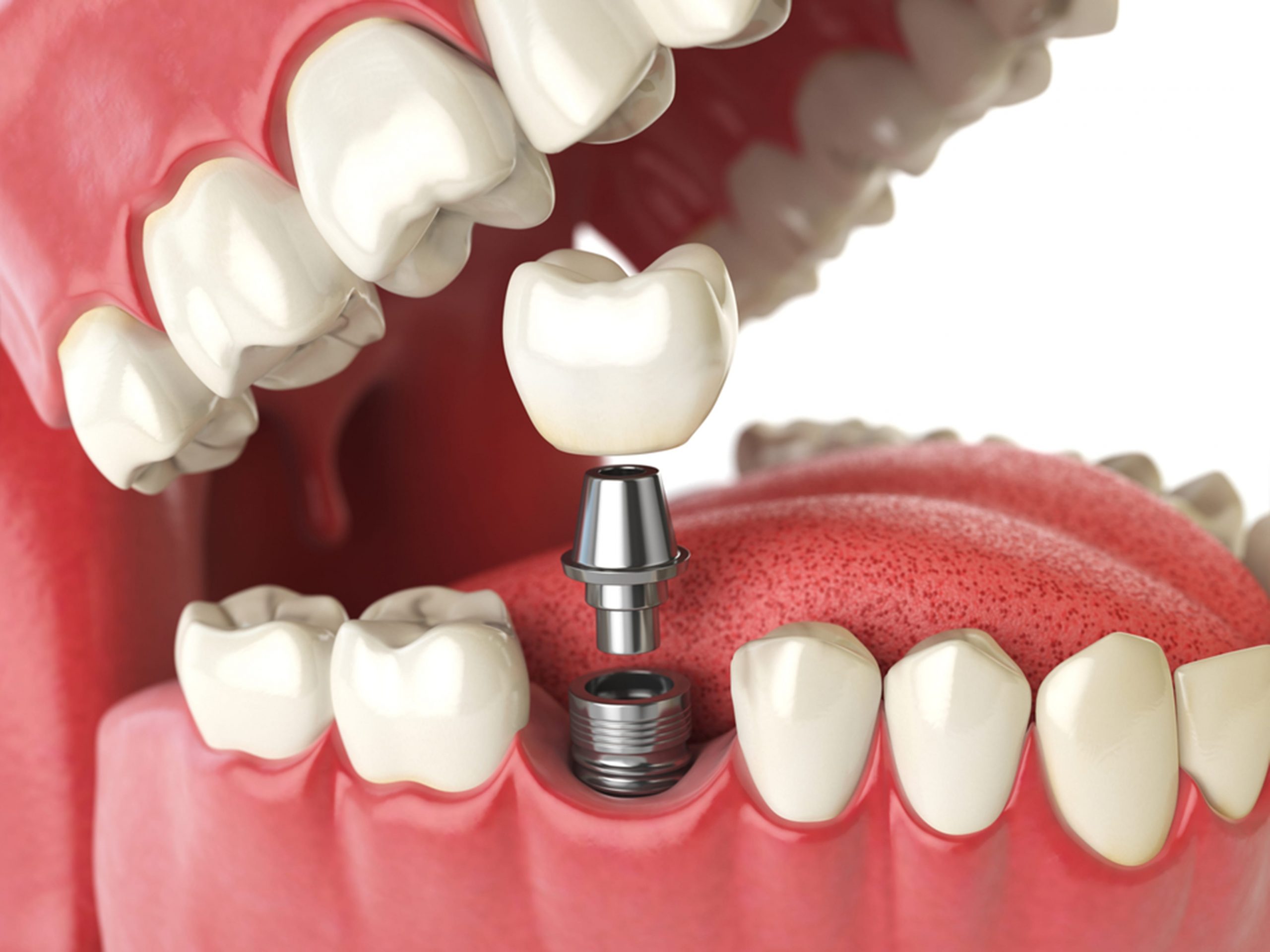 dental implants in Winnipeg