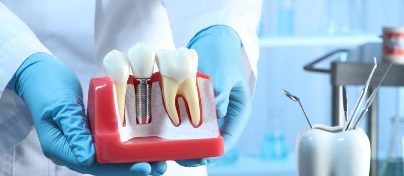 how do you clean dental implants